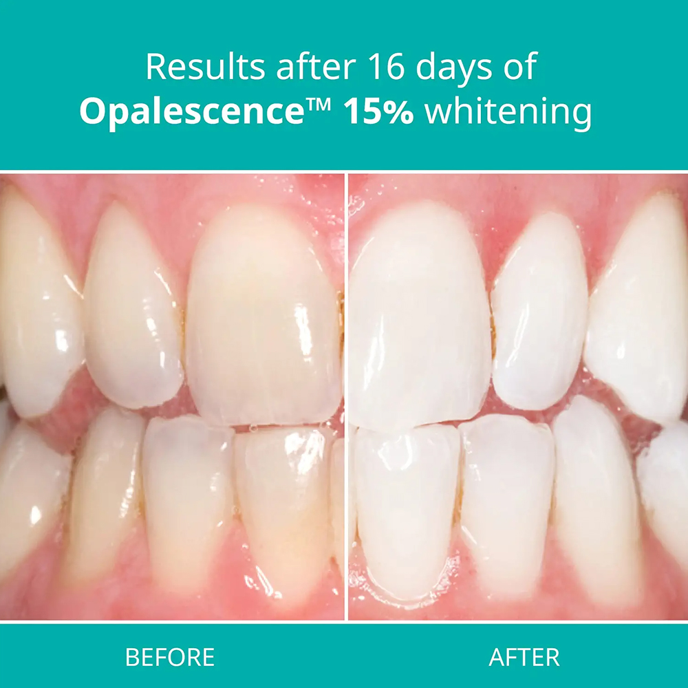 Opalescence Professional White – Teeth Whitening Gel Refills recenzja i cena