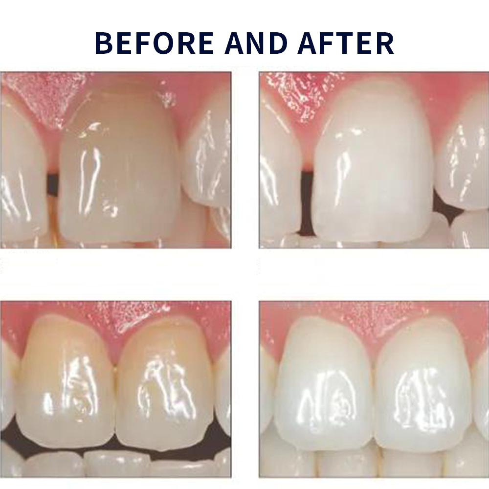 Opalescence Whitening 20% PF 2 – Teeth Whitening Kit At Home recenzja i cena