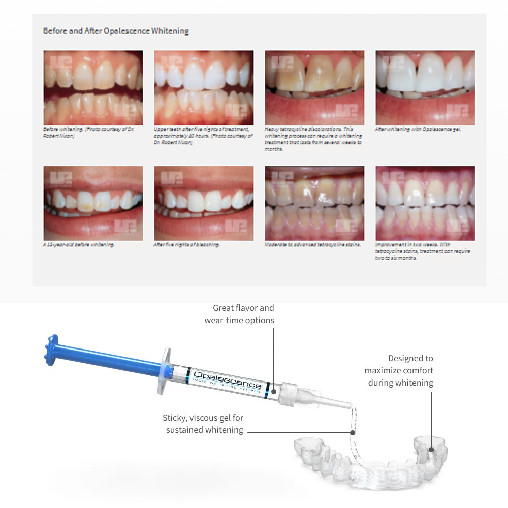 Opalescence Whitening 20% PF 2 – Teeth Whitening Kit At Home recenzja i cena