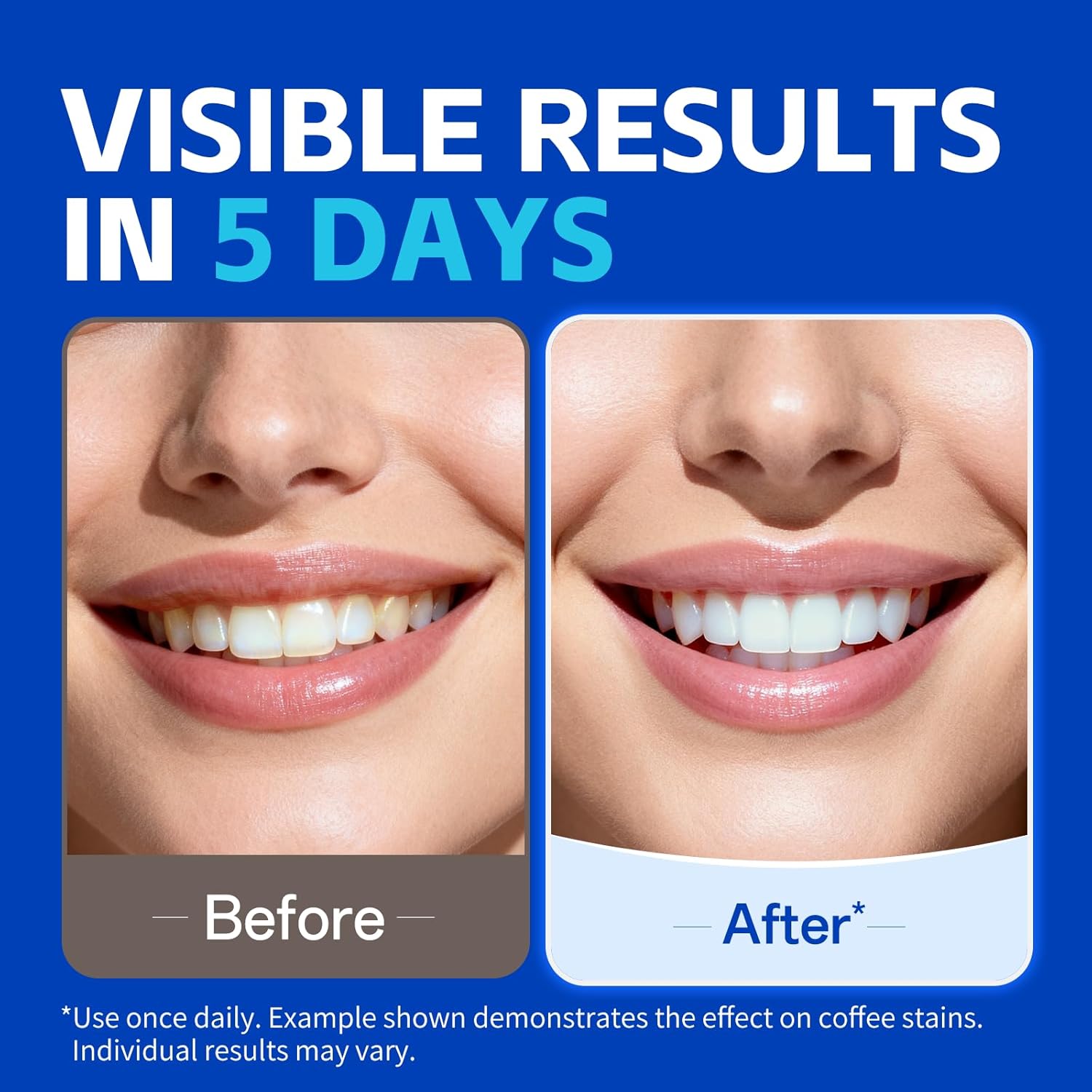 1/7 Par Pasków do Wybielania Z – Teeth Whitening Street recenzja i cena