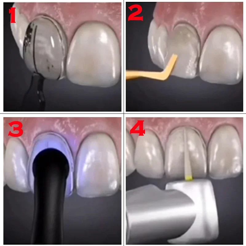 Formy dentystyczne do licówek  – Teeth Whitening Moulds recenzja i cena