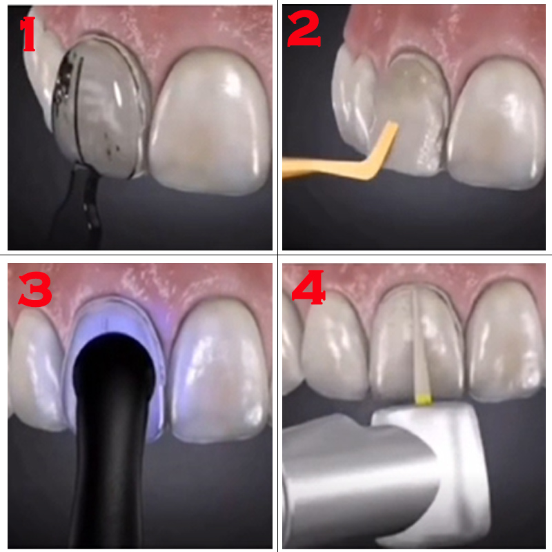 Zestaw 32 szt. form do licówek – Teeth Whitening Moulds recenzja i cena