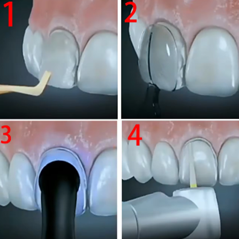 32 sztuk/pudło zestaw fornirów – Teeth Whitening Moulds recenzja i cena